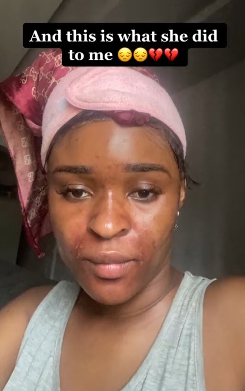 “What did I do to deserve this?” – Nigerian Lady cries out after her mother’s househelp tried to disfigure her face (video)