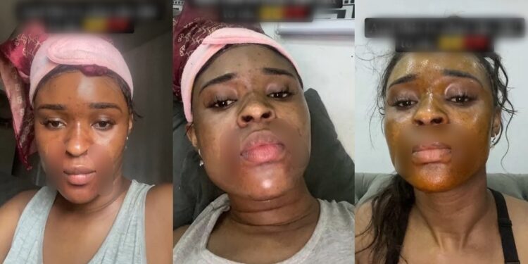 “What did I do to deserve this?” – Nigerian Lady cries out after her mother’s househelp tried to disfigure her face (video)