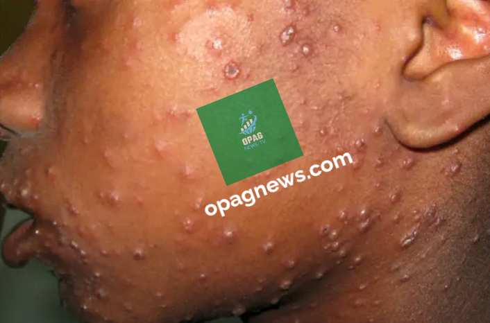 Measles infection